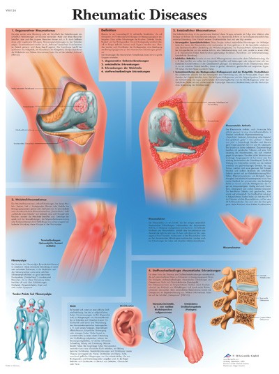 All Products - Wandkaart: Rheumatic Diseases