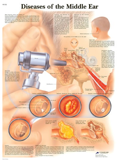 All Products - Wandkaart: Diseases Of The Middle Ear