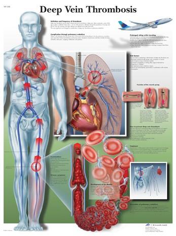 All Products - Deep Vein Thrombosis